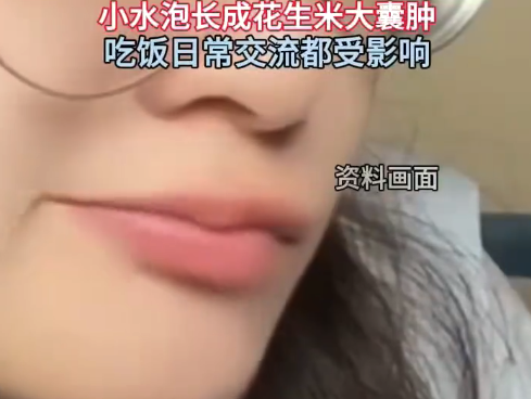 压力山大!28岁女子嘴唇囊肿竟是咬出来的