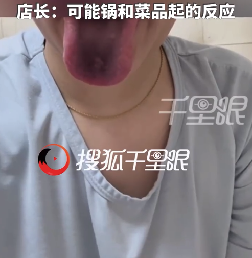 女子称吃火锅后舌头发黑疑亚硝酸盐中毒