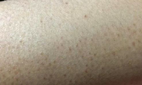 引起鸡皮肤的原因其具体病因尚不完全清楚,但目前认为与下面因素有关