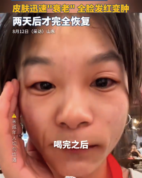 女生酒精过敏皮肤瞬间衰老 两天后才完全恢复