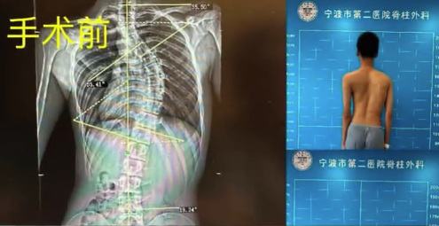 男孩脊柱扭成S形背部植入18颗螺钉