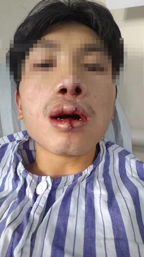 24岁唇腭裂患者接受了免费手术 嫣然天使基金会助力重绽笑颜