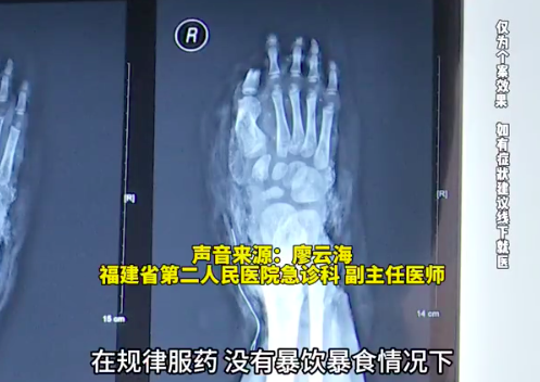 泡面竟是痛风的