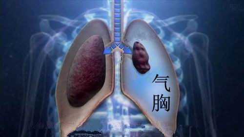 杭州18岁男生肺“炸”了，医生：怎么又是你！