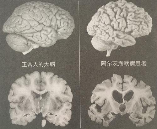 有痴呆倾向的人常说4句话 识别早期预警信号