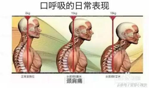 口呼吸会让人变丑是真的吗 经口呼吸面容图片大全