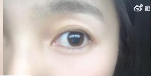 女子瞳孔变大找不到病因 视物模糊还很畏光比正常大2倍
