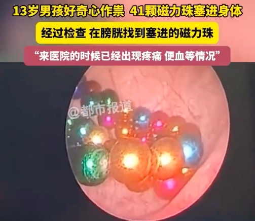 13岁男孩好奇往尿道塞41颗磁力珠 医生称曾接诊尿道塞铁钉男孩