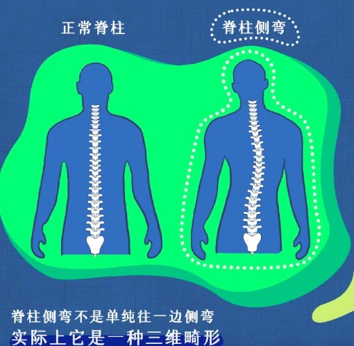孩子脊柱侧弯了还以为是体态不好 听着"小众"却是危害健康的第三大"杀手"！