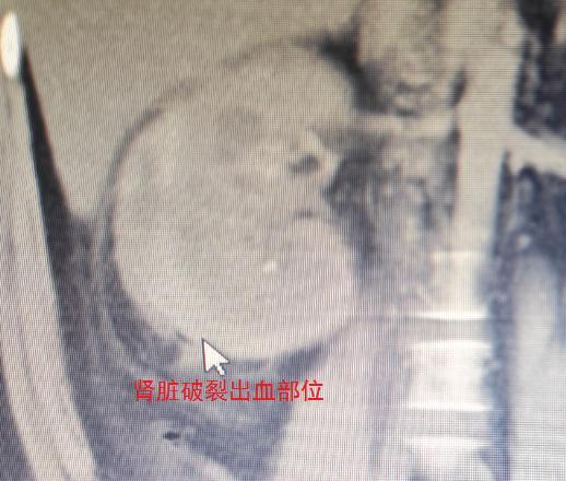 男子用筋膜枪锤腰肾被震破 结石没了，肾也破了