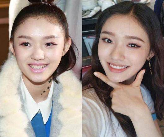 娱乐圈中整牙如换脸的明星,前后对比照看过之后真是大跌眼镜!
