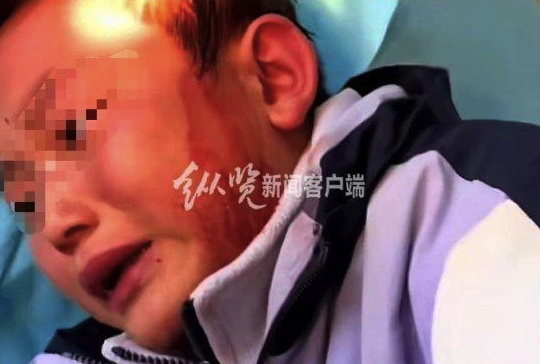 云南8岁小学生因卷子破损被老师用戒尺打破头