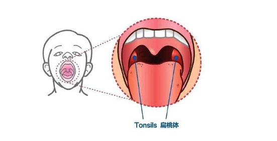 扁桃体结石是什么样子图片 扁桃体结石会一直长吗?