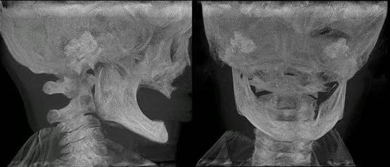4岁男童患罕见无牙症 颌骨薄如纸片：天生没有牙齿，该怎么吃饭？