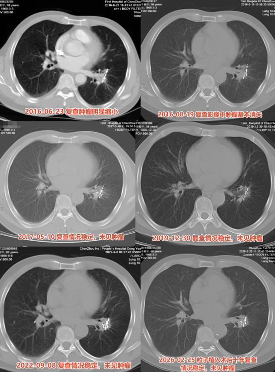 65岁爷爷患肺癌晚期存活10年 精准治疗创奇迹