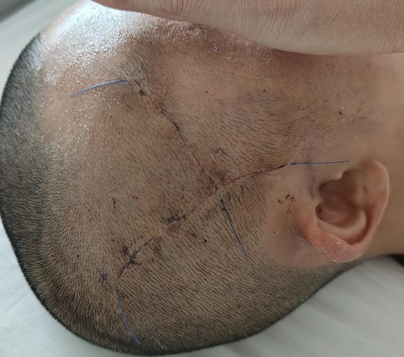 女子年年脑梗一查是罕见烟雾病 罕见病因需警惕