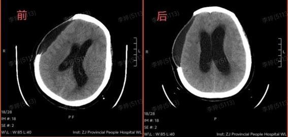 高溫曬背2小時(shí)67歲阿姨竟開(kāi)顱保命