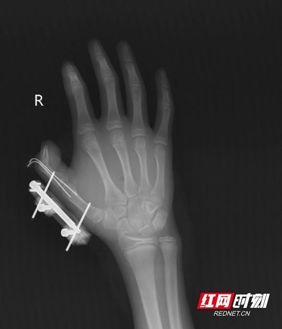 少年摇晃干冰玩耍时突发爆炸