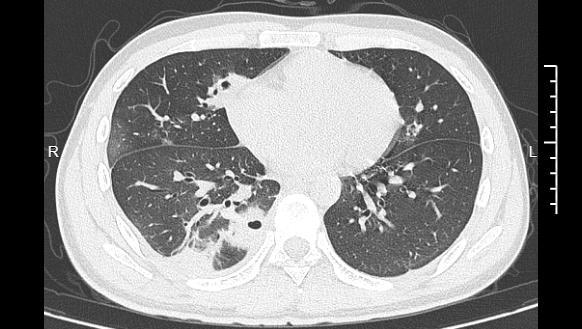 20岁男生肺被“啃”出10多个空洞 挤痘引发严重感染