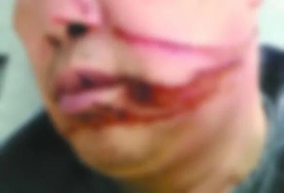 风筝线又伤人 男子骑车遭“割脸”