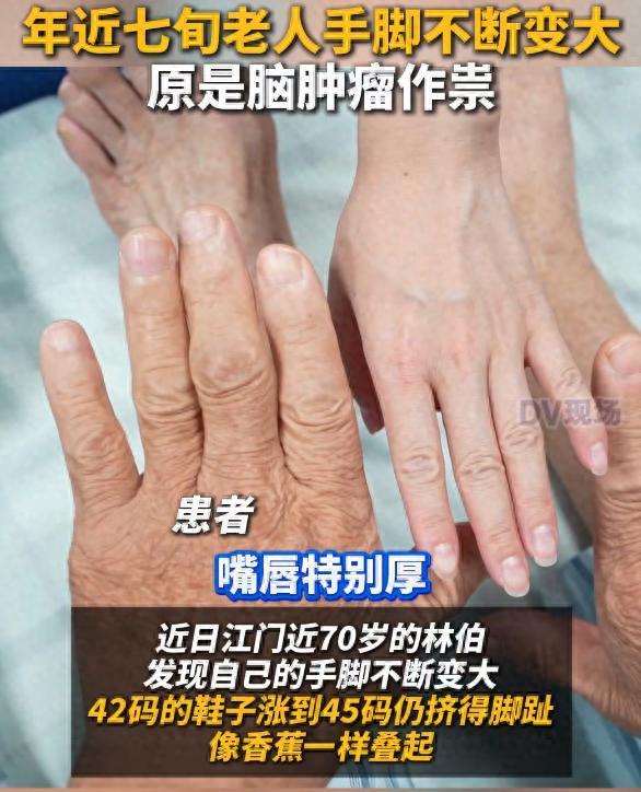 七旬老人手腳變大原是腦腫瘤作祟 醫(yī)生提醒：看似平常的身體變化，可能是疾病發(fā)出的“求救信號”