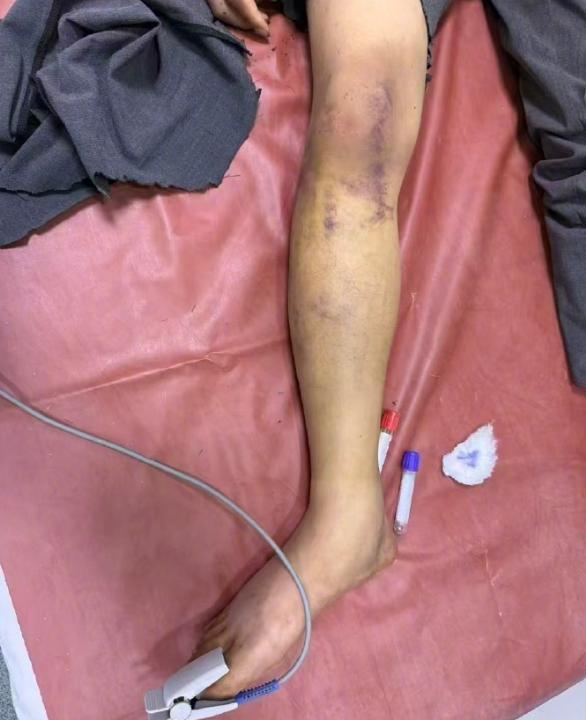 27岁中国网红在非洲遭绑架虐待，手脚被打断 拒绝诈骗惨遭毒手