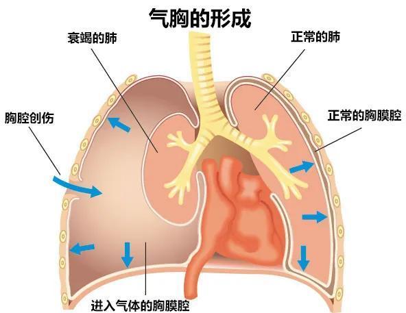 什么是爆肺 氣胸引發(fā)關(guān)注