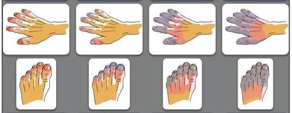 寒潮来袭警惕冻伤 低温冻伤勿轻慢