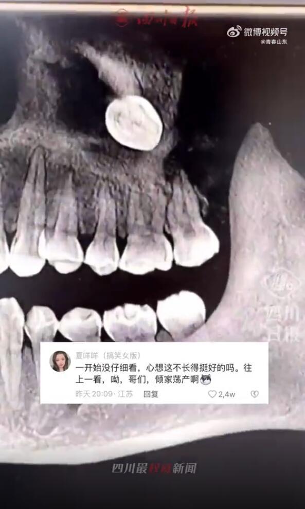 女子智齿位置奇特目测要背井离乡