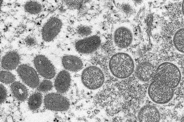 英专家称猴痘已在英国普通人中传播 病例将增加