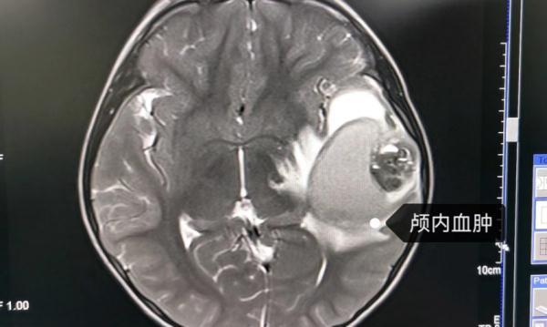 警惕！福州7岁女童因脑血管畸形突发脑出血！这病致死率高！出现以下情况 请立即就医