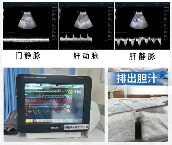 世界首例我国完成基因编辑猪人异种肝脏移植
