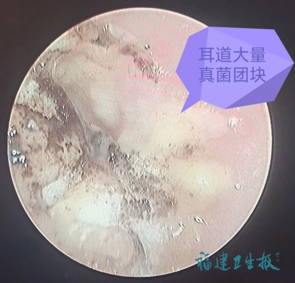 女子耳朵里长“脚气” 医生提醒：平时尽量少掏耳朵
