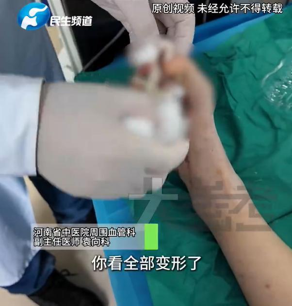 20岁姑娘一天4杯全塘奶茶咖啡险截肢 糖尿病足警示