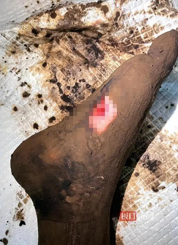 男子被毒蛇咬伤后拍下蛇的照片并就医 散步时遭遇惊魂一刻