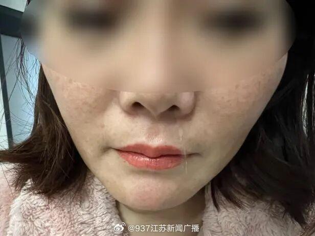 女子流了6年鼻涕竟是脑脊液