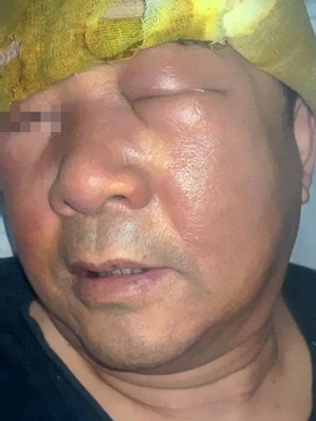 66歲大爺挖鼻孔致滿臉腫脹變形 丹毒來襲