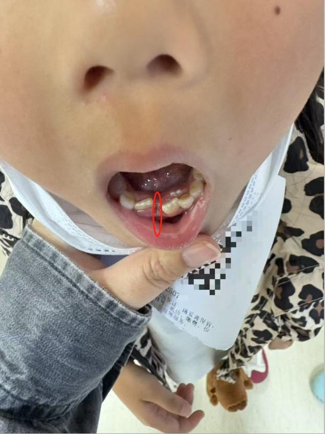 昆明7岁女童拔乳牙时被错拔恒牙 家长诊所各执一词