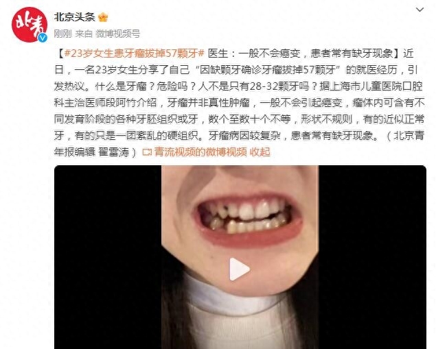 吓人！23岁女孩拔出57颗牙 医生：因缺牙确诊牙瘤 一般不会癌变