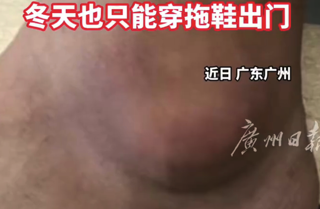 21岁小伙恒久熬夜吃麻辣烫 脚踝长痛风石大如乒乓球