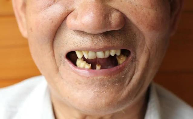 80岁啃排骨不费劲，50岁却戴假牙？医生揭秘牙齿真相