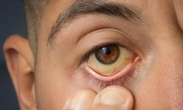 眼白发黄藏大病？5种异常信号，千万别不当回事！