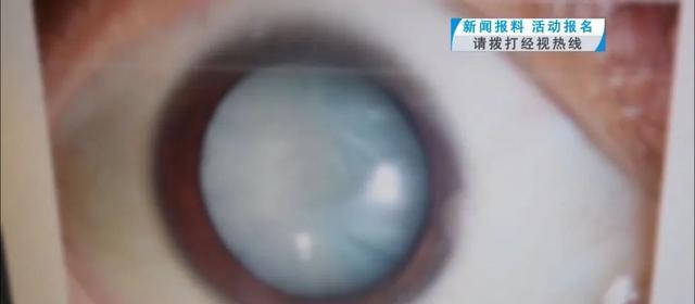 25岁小伙瞳孔全白！这个致盲习惯要当心