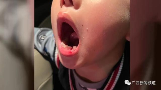 6岁男童被钢琴老师扇掉一颗牙