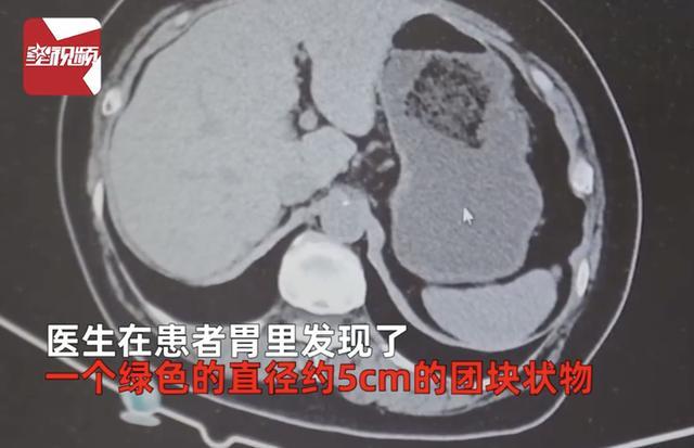 男子胃结石医生开药2大瓶可乐 网友：知道了，吃柿子要炫可乐