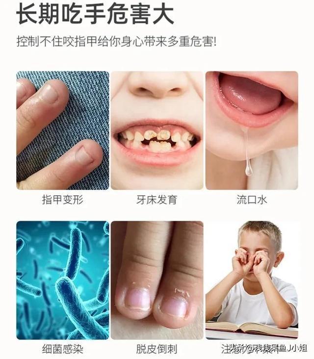 男孩啃秃指甲引发骨髓炎 网友：30岁的我慢慢的放下了嘴边的手