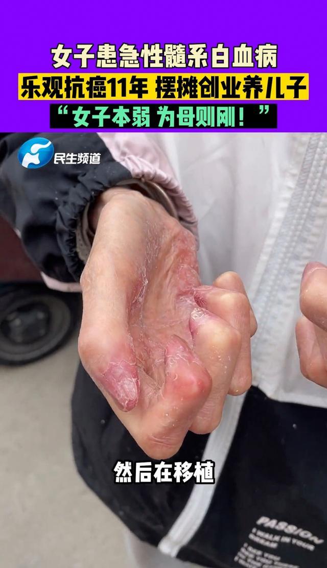 女子患急性髓系白血病 乐观抗癌摆摊11年养儿子