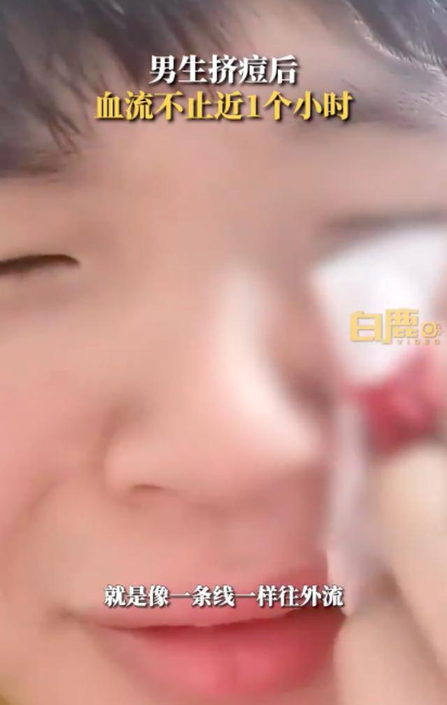男生挤痘后流血近一小时 无论痘痘处于哪个阶段，都不建议大家自行挤压