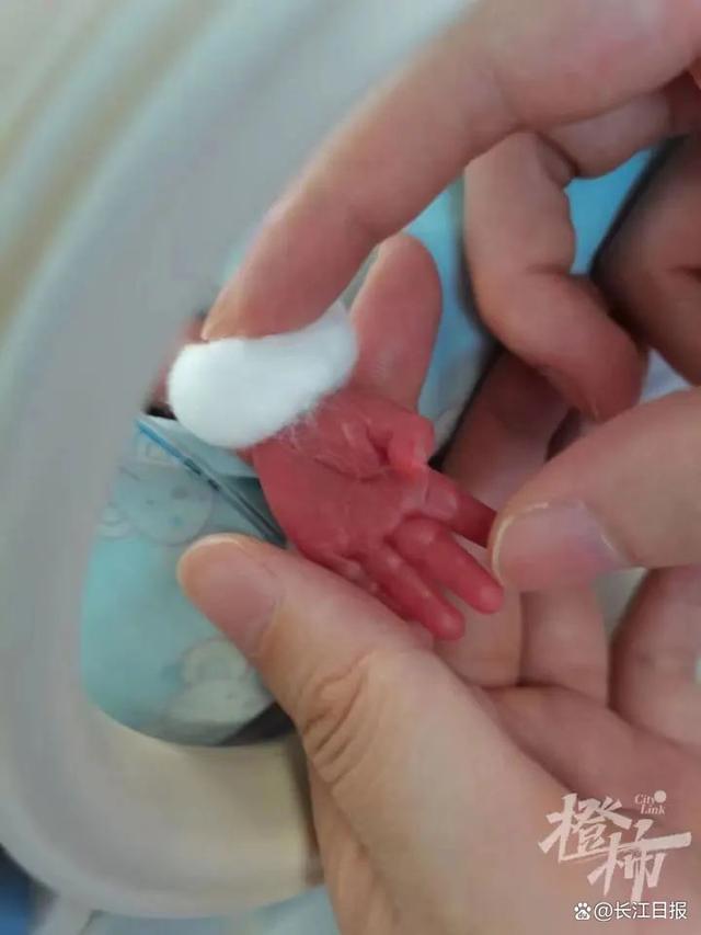 750克超早产宝宝救治后健康出院：婴儿跟手掌差不多大！
