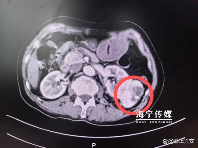警惕：无任何症状！浙江一女子摔伤后做检查被查出肾癌